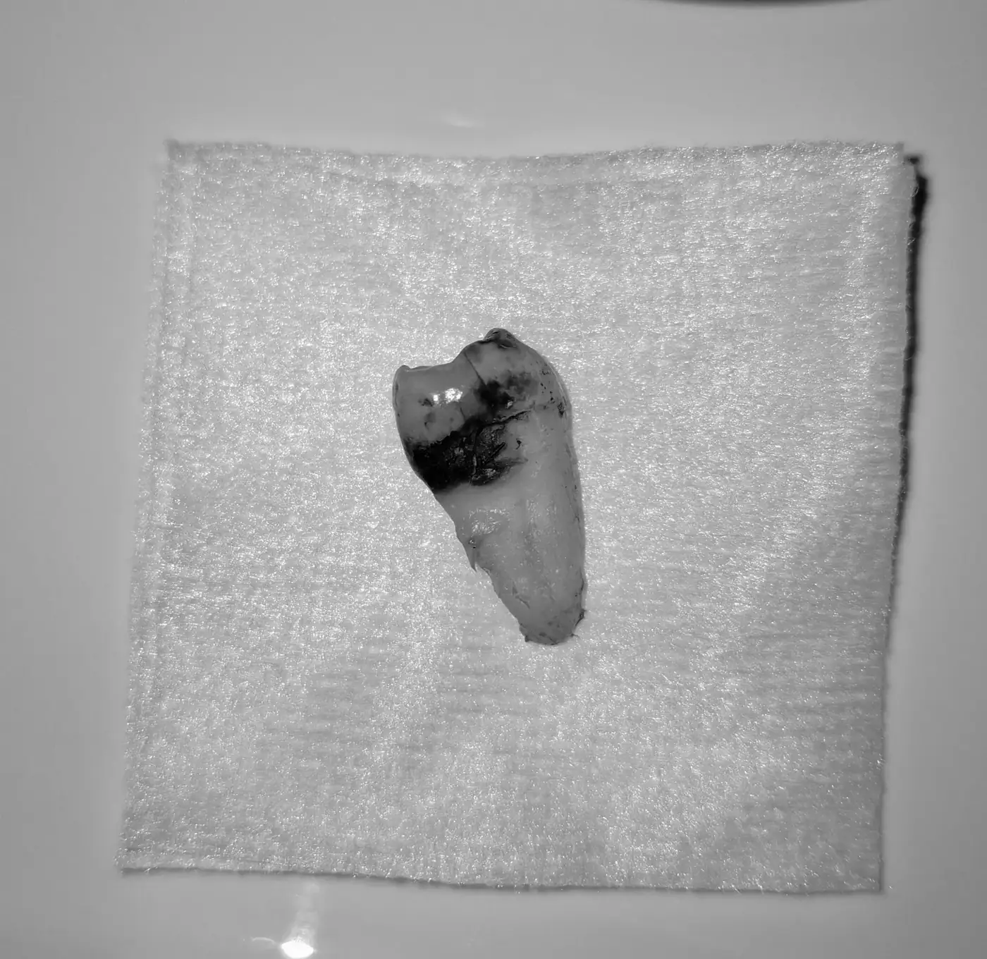 Extracción dental